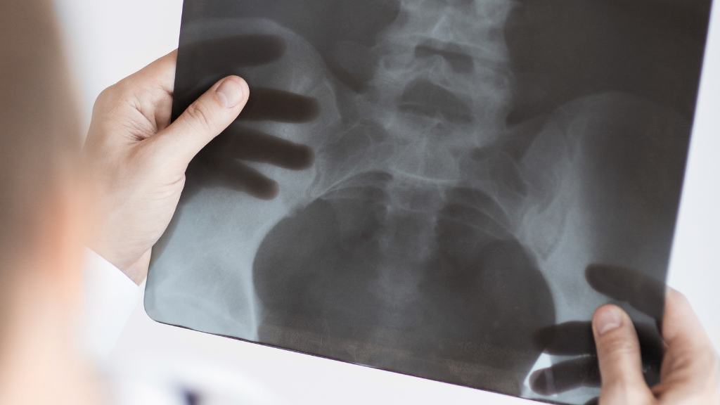 Per chi è indicata la chirurgia per l'ernia del disco